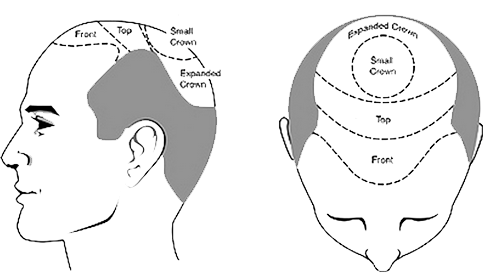 cost-of-hair-transplant cost-of-hair-transplant