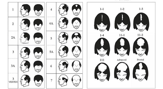 hair loss types