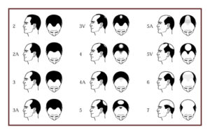 hairlosschart