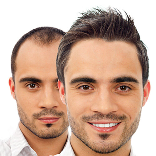 dhi hair transplant